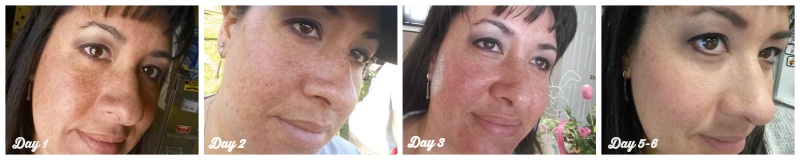 CosmetiCare Results for Rejuvenize Peel CosmetiCareMoms