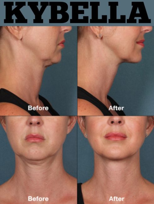 Before and After Exploring Kybella CosmetiCare