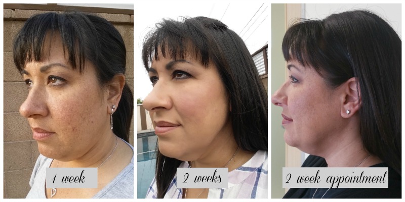 Kybella - My First Appointment with Cosmeticare