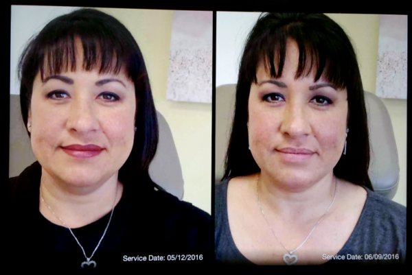 Kybella Results - My Transformation with CosmetiCare - Balancing The Chaos
