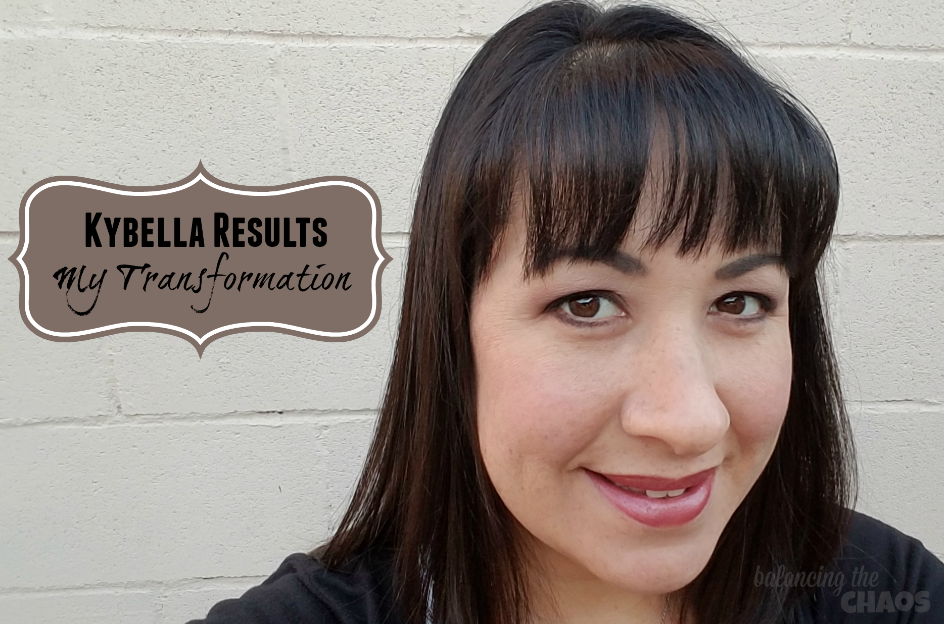 Kybella Results My Final Results and Transformation