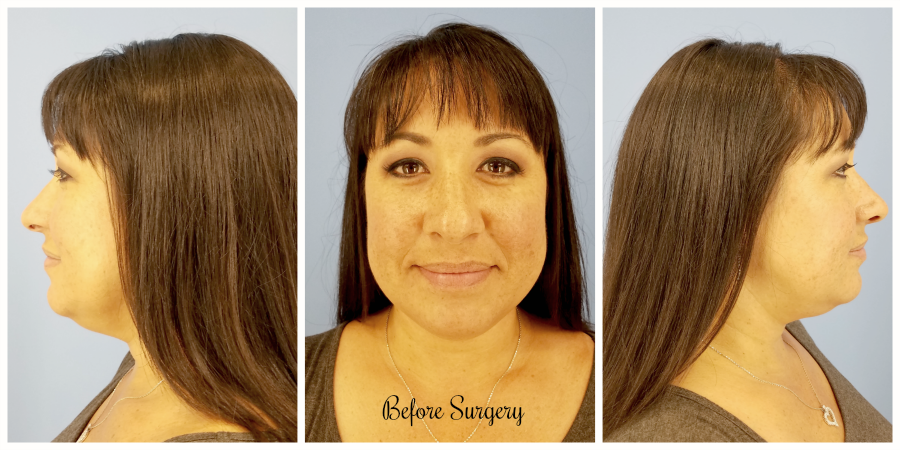 CosmetiCare Before Rhinoplasty Surgery