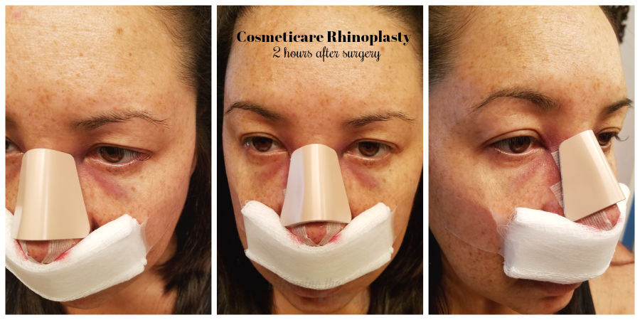 CosmetiCare Rhinoplasty 2 hours after surgery