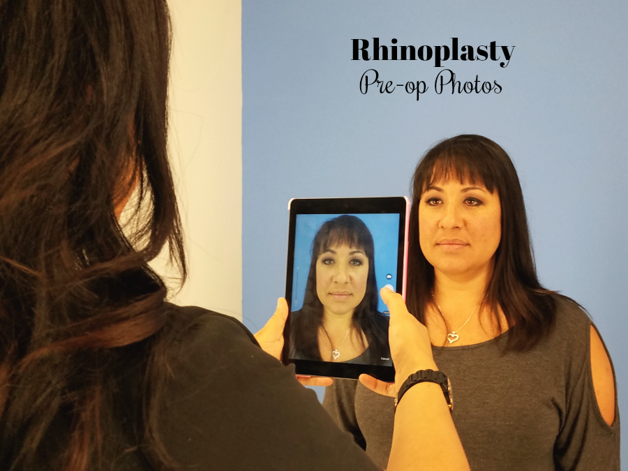 Rhinoplasty Pre op Photos