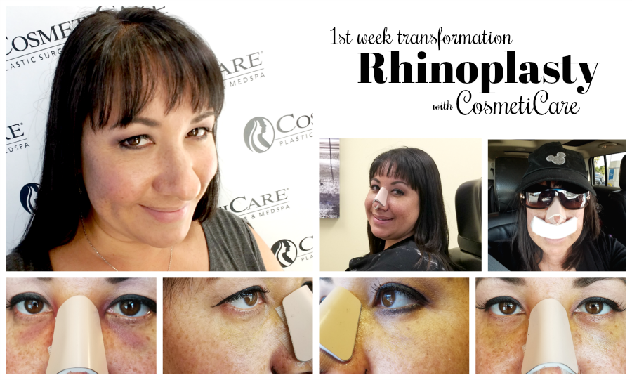 CosmetiCare Rhinoplasty 1st Week Transformation