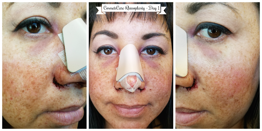 CosmetiCare Rhinoplasty Day 1 