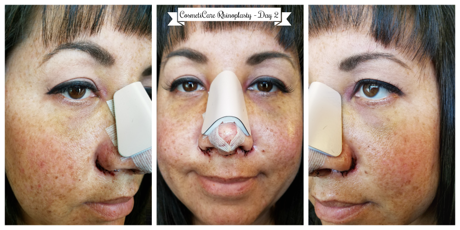 CosmetiCare Rhinoplasty Day 2 