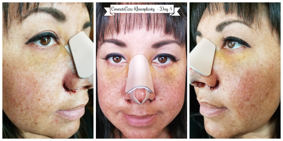 CosmetiCare Rhinoplasty Day 4