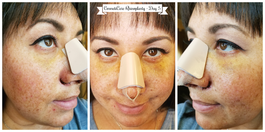 CosmetiCare Rhinoplasty Day 5