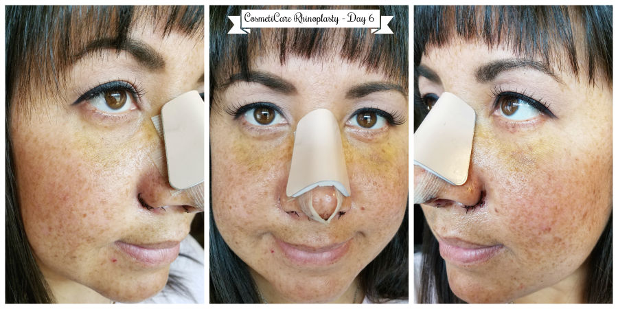 CosmetiCare Rhinoplasty Day 6 