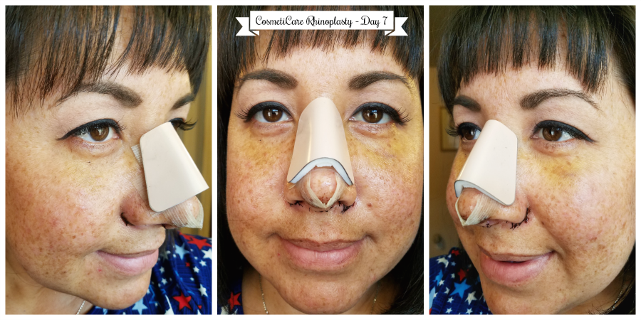 CosmetiCare Rhinoplasty Day 7 