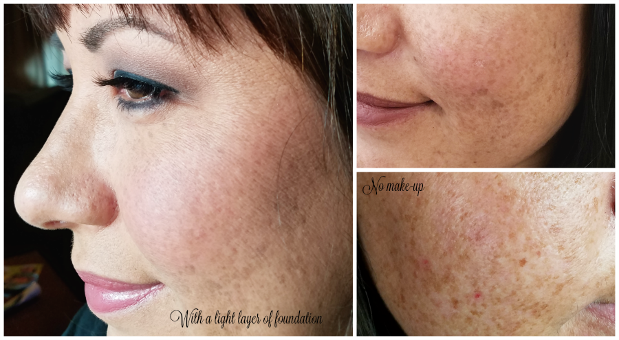 Actual skin town before peel with cosmeticare; 5 types of peels at CosmetiCare