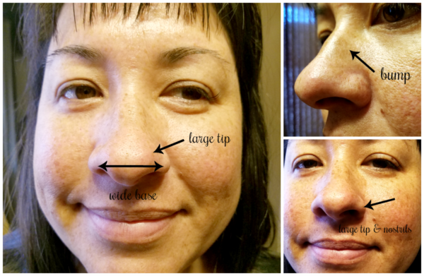 Rhinoplasty Results: 3 Months After Surgery | @CosmetiCare # ...