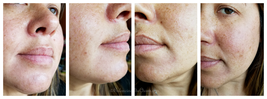 Results of chemical peel with CosmetiCare