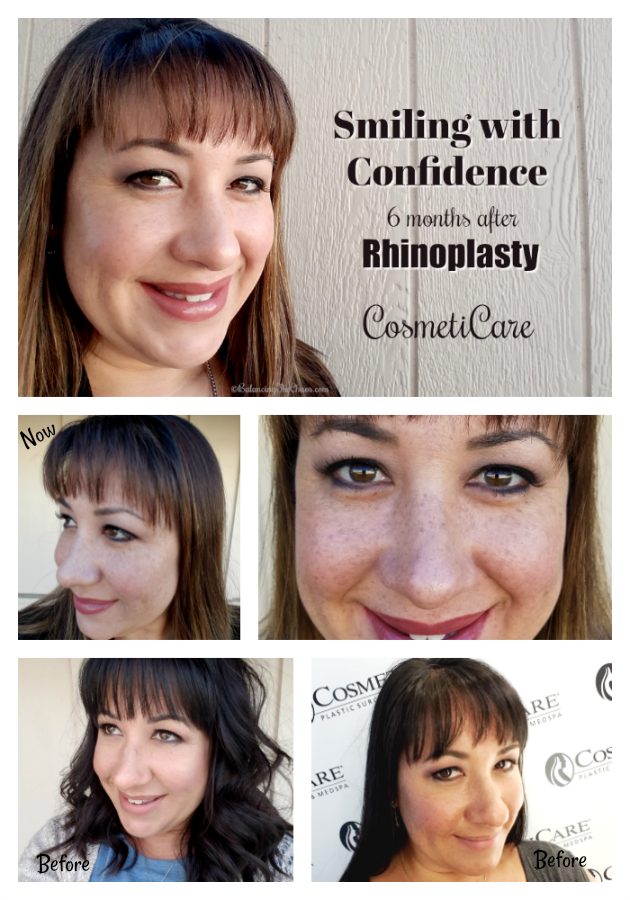 Smiling with Confidence 6 months after Rhinoplasty Surgery CosmetiCare