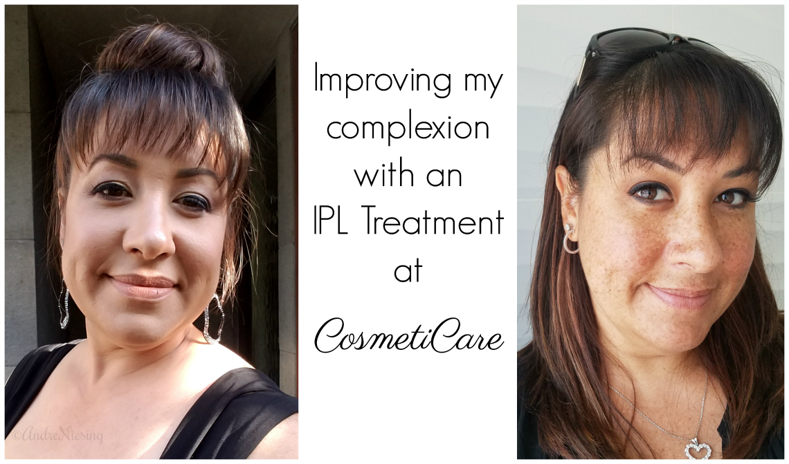 Improving my complexion with IPL