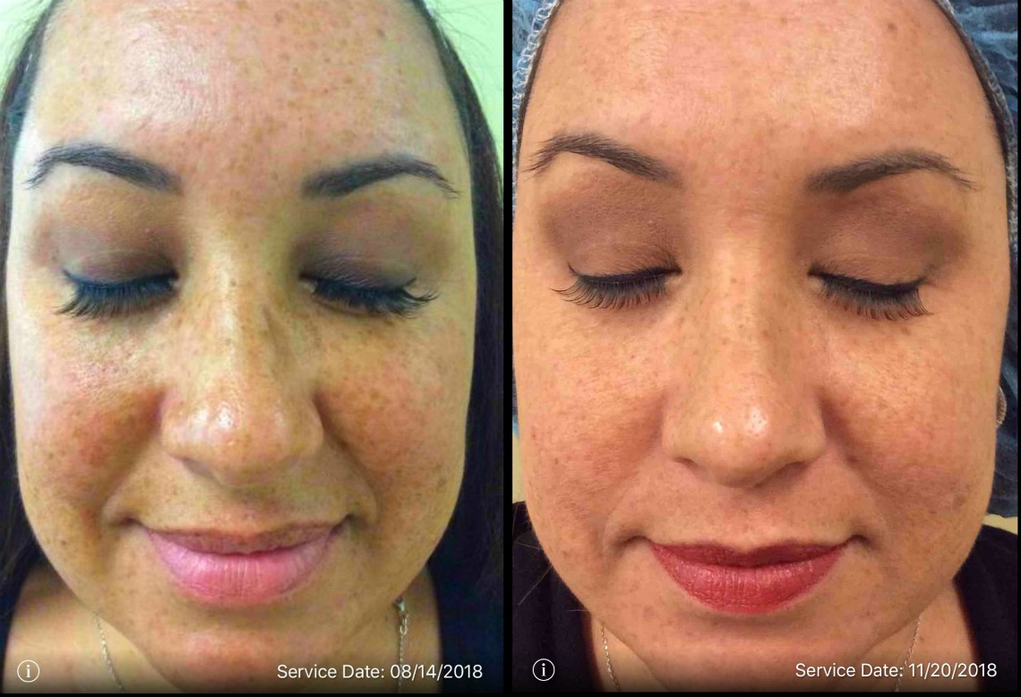 The Results of an IPL Treatment at CosmetiCare - Balancing ...