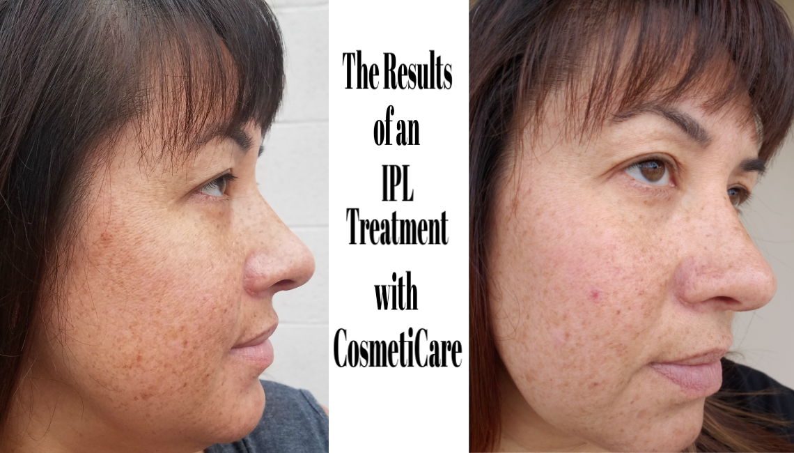 Results of IPL Treatment with CosmetiCare