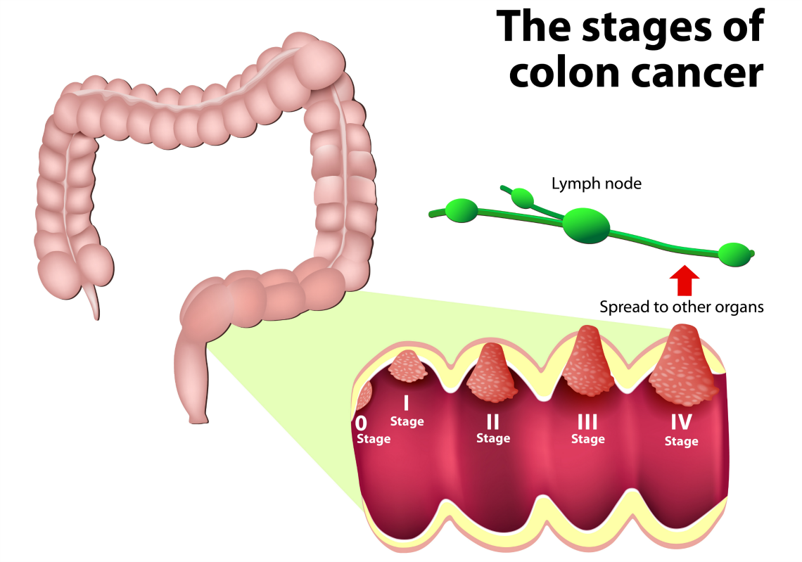 Stages of Colon Cancer
Interview with Kaiser Permanente Physicians
Shutterstock: 236512159
By Designua