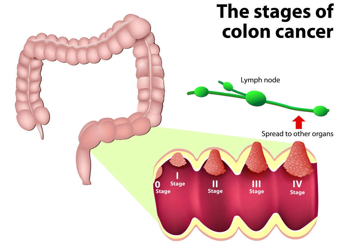 Tips to Prevent and Identify Colon Cancer - Balancing The Chaos